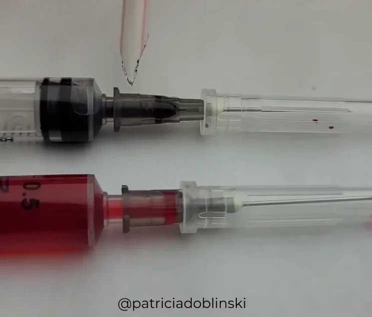 Comparativo de aspiração: seringa superior sem sangue no canhão; seringa inferior com sangue visível no canhão e no corpo